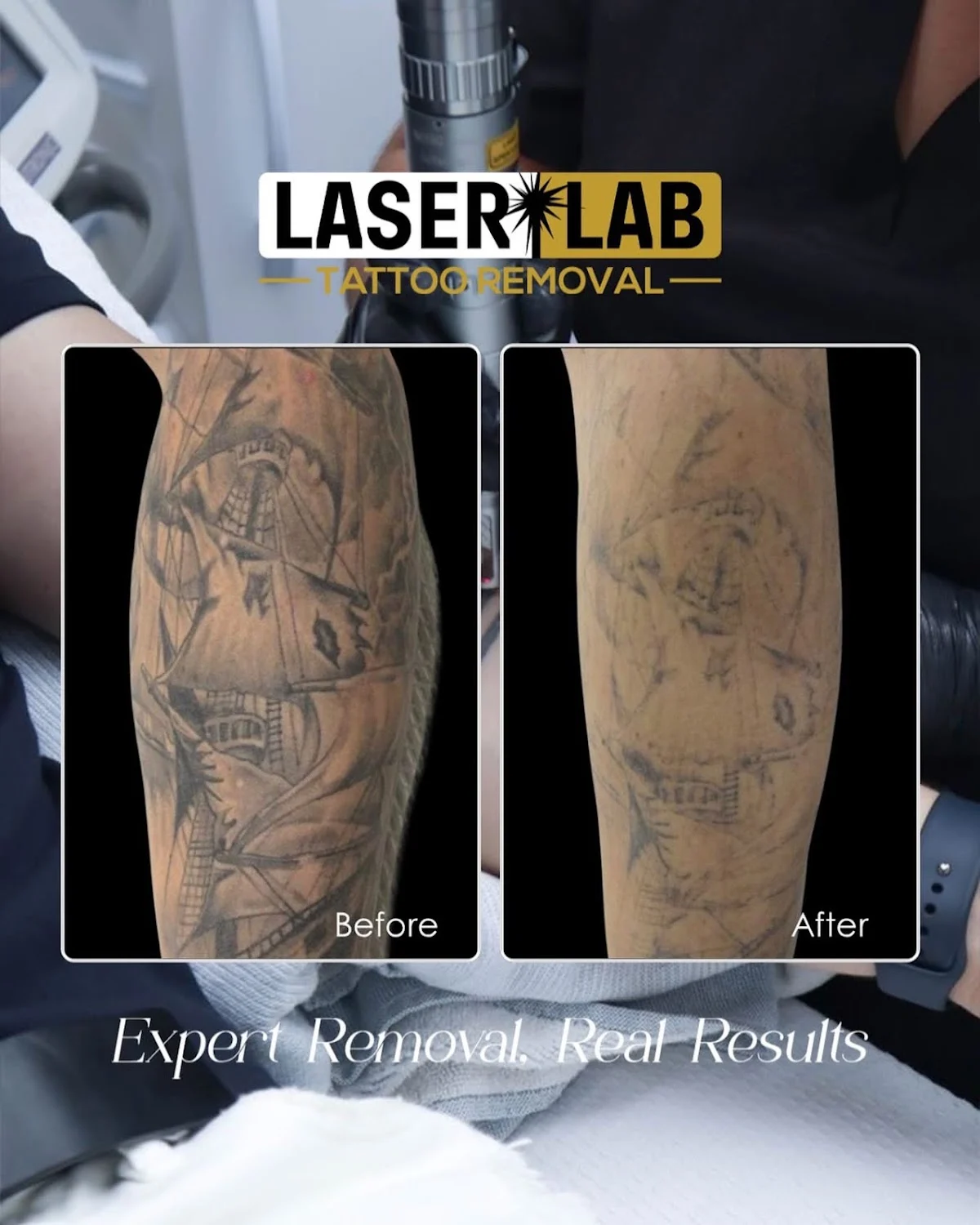 Laser Lab Tattoo Removal Cairns