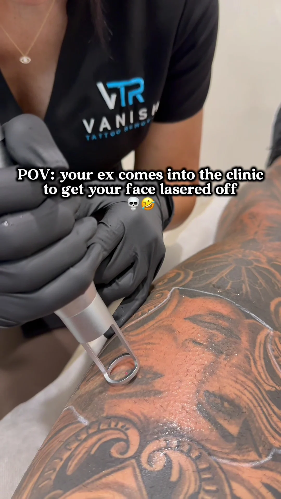 Vanish Tattoo Removal